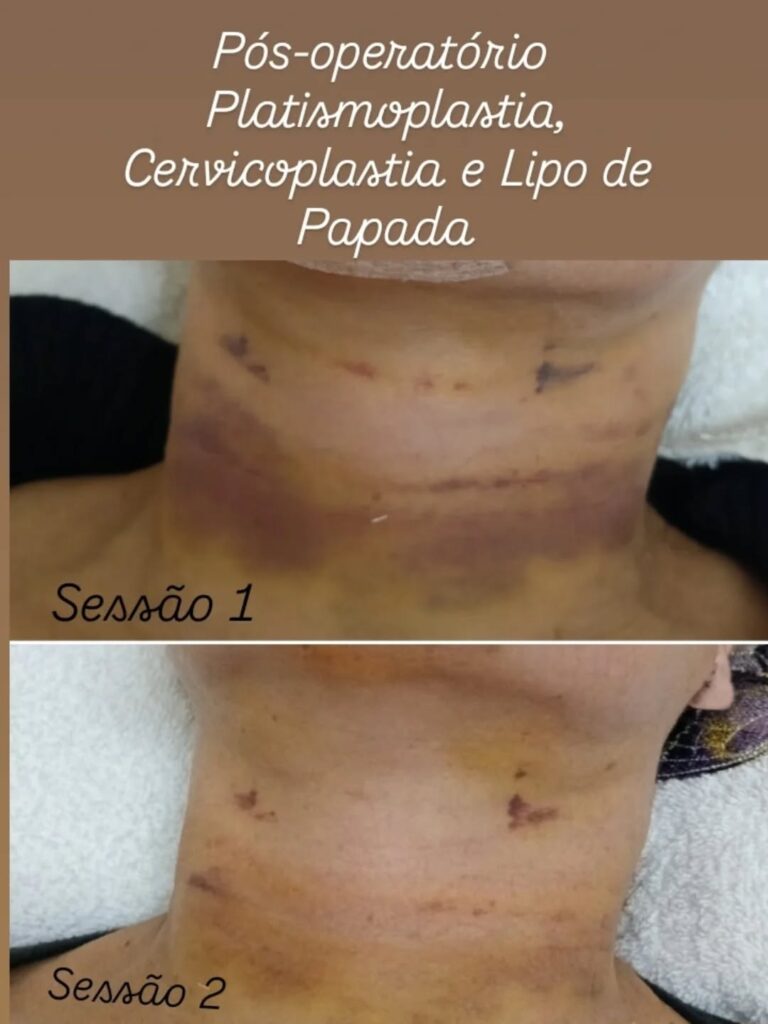 Pós-operatório de platismaoplastia, cervicoplastia e lipo de papada com evidências visuais de hematomas e redução de marcas entre a sessão 1 e sessão 2, indicando avanço no processo de recuperação estética do pescoço.