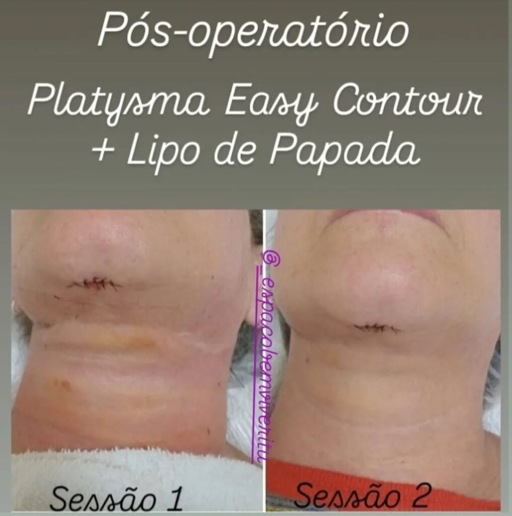 Pós-operatório de Platysma Easy Contour e lipo de papada, comparando a evolução entre a primeira e a segunda sessão de tratamento estético, mostrando melhora no inchaço e cicatrização sob o queixo.
